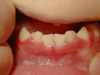 ヘルペス性歯肉炎下顎