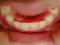 交換期　下顎前歯